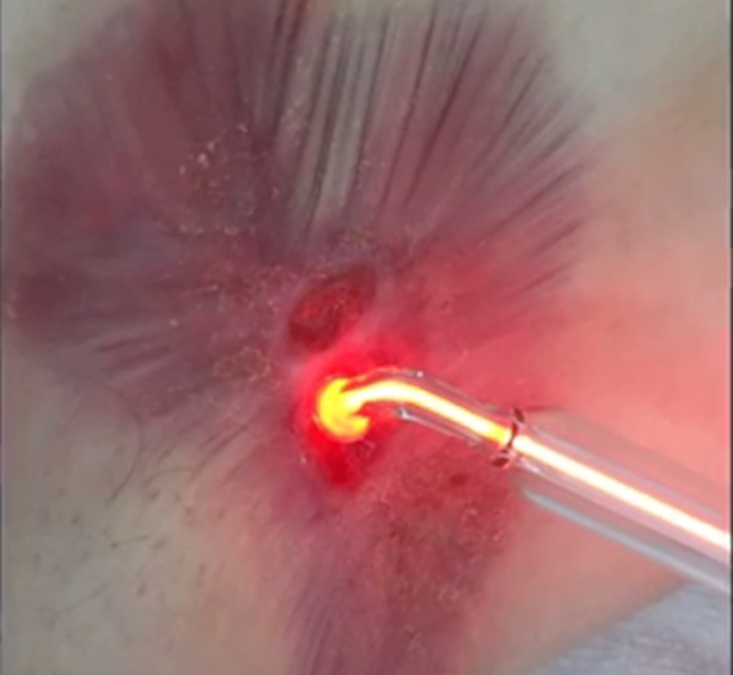 Kalt-Plasma-Behandlung – neue Wege im Wundmanagement