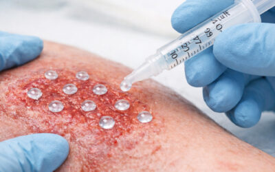 Beremagen geperpavec: Gentherapie für Wundversorgung bei dystropher Epidermolysis bullosa