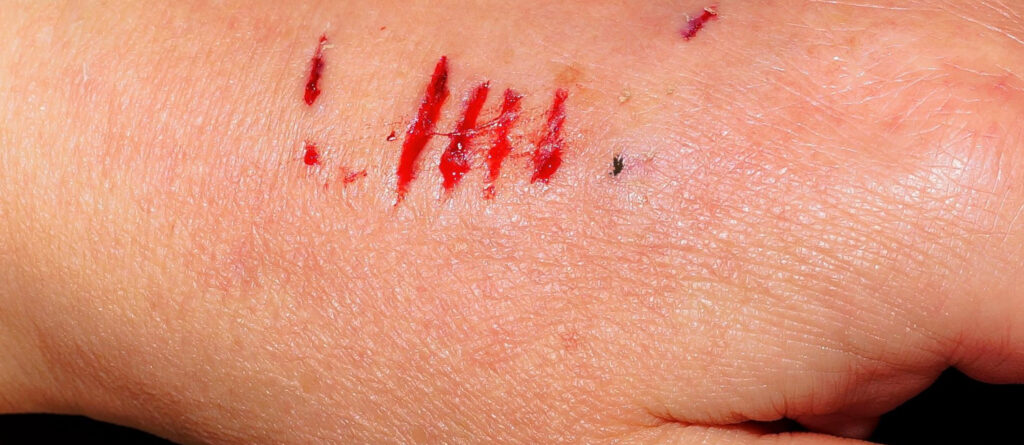 Bisswunde an einer Hand, die weniger senkrechte Einstiche zeigt, sondern vielmehr mehrere blutige parallele Kratzer.