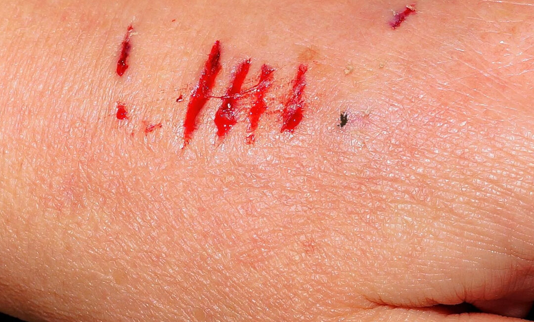 Bisswunde an einer Hand, die weniger senkrechte Einstiche zeigt, sondern vielmehr mehrere blutige parallele Kratzer.