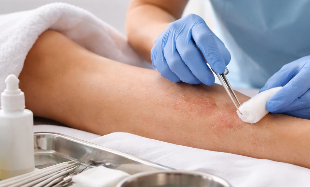 Debridement in der Praxis: Strukturierte Strategien für erfolgreiches Wundmanagement